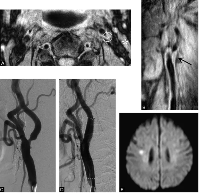 Fig. 2    Example of CAS using F-DPD to treat an asymptomatic 67-year-old male.