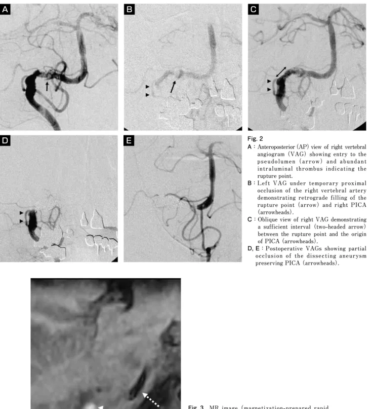 Fig. 3  MR  image #magnetization-prepared  rapid  gradient  echo:  MPRAGE!  obtained  '  days  after the treatment showing a high intensity area  adjacent  to  the  vertebral  artery  corresponding  to  intramural  hematoma #arrowheads!.  Arrow  indicates 