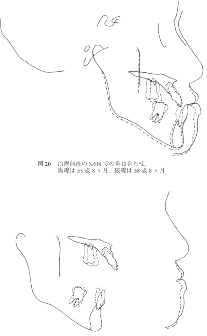 図 22 保定開始後 18 ヶ月 被蓋は維持している．下顎右側犬歯遠心にスペースが生じているが，患者さんは 今のところ再治療を希望していない．図 21 治療前後の上下顎骨および軟組織の重ね合わせ．黒線は35歳8ヶ月，破線は38歳8ヶ月図20 治療前後のS-SNでの重ね合わせ．黒線は35歳8ヶ月，破線は38歳8ヶ月