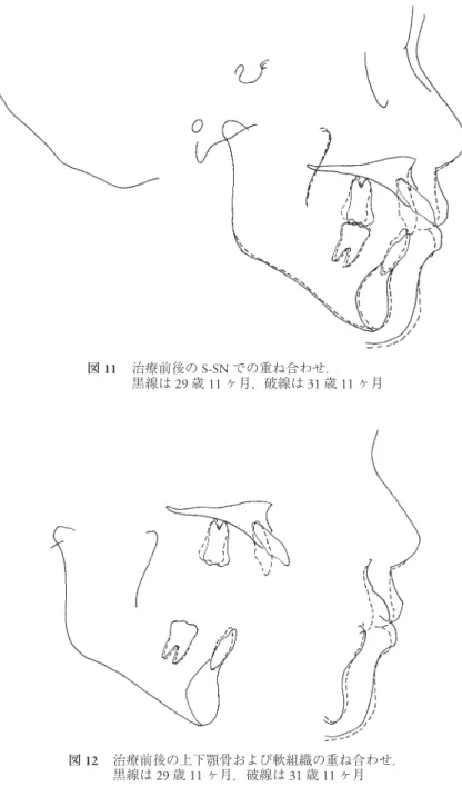 図 13 保定開始後 2 年 11 ヶ月 途中第三子を出産した際，上顎リテーナーを使用せず前歯部の配列に乱れが生じた． Overbite, overjet は維持している．図12  治療前後の上下顎骨および軟組織の重ね合わせ．黒線は29歳11ヶ月，破線は31歳11ヶ月図11 治療前後のS-SNでの重ね合わせ．黒線は29歳11ヶ月，破線は31歳11ヶ月
