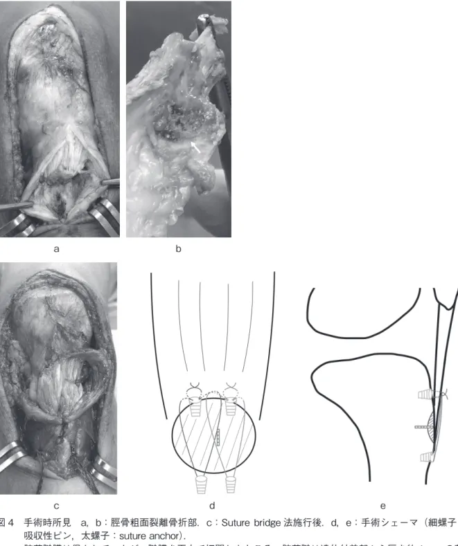 図 4　手術時所見　a，b：脛骨粗面裂離骨折部．c：Suture bridge 法施行後．d，e：手術シェーマ（細螺子：