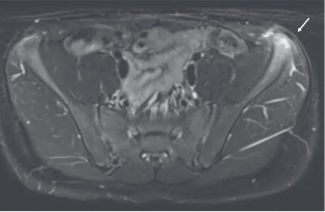 図 1　ASIS 骨端部の MRI（T2 強調脂肪抑制　横断像）