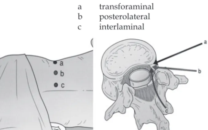図 3　transforaminal approach で施行するシェーマ