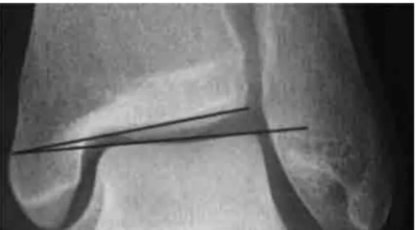 図 2　距骨傾斜角（talar tilt angle；TTA）の測定