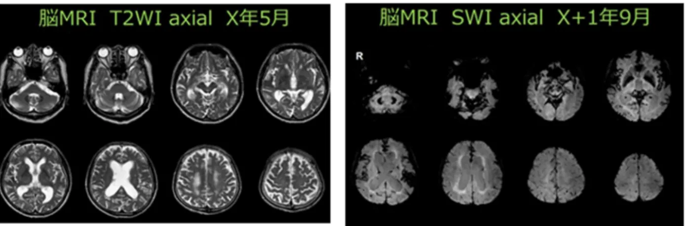 図  頭部 MRI：MRI では、側脳室の拡大を主体とする大脳萎縮あり、小脳皮質に帯状、また側頭極の脳 表に SWI 低信号を認めた。小脳は歯状核というよりむしろ皮質に出血と判断される SWI 低信号を 示した。大脳では、アミロイドアンギオパチーでしばしば認めるような皮質の SWI 低信号を散見 した。  脳血流 Tc-ECD  SPECT では、側頭頭頂葉移行部を中心として、帯状回や前頭極において血流低下 を認めた。 