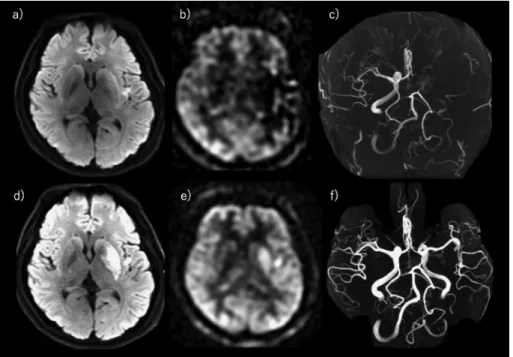Fig. 6. Representative ASL images in a case of hyperacute cerebral infarction. Case : A man in his 40s
