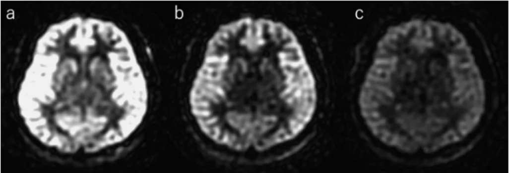 Fig. 9. Comparison of ASL images without vessel suppression (a), with MSDE (b), and with DANTE (c).