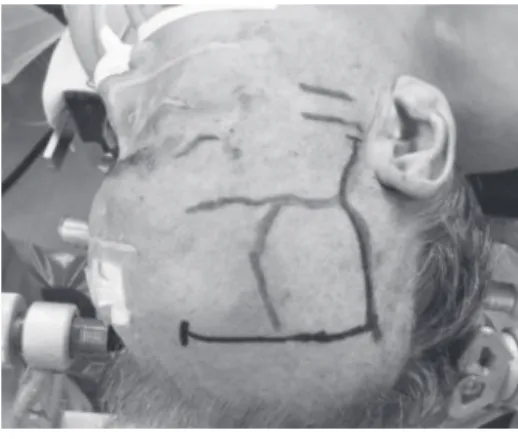 Fig. 1  Skin incision along the parietal branch  of the superficial temporal artery  (STA) and the incision are stretched  forward.
