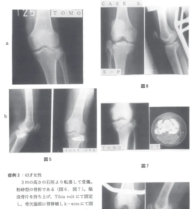 図 5 症例 3：43 才女性 　3 m の高さの石垣より転落して受傷。 粉砕型の骨折である（図６．図７）。陥 没骨片を持ち上げ，Tibia  volt にて固定 し，骨欠損部に骨移植し k-wire にて固 定した（図８）。術後 ROM は，－ 10°～ 120°である（図 ９ ）。 症例 4：72 才男性 　バイクで走行中ネコが前方を通ったた め急ブレーキをかけたところ転倒した。 粉砕型の骨折であり陥没部分を整復し，