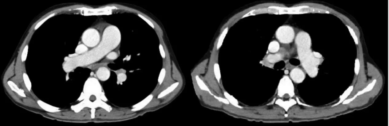 Fig. 2 Contrast-enhanced CT scan showing no thrombus in the main pulmonary trunk.