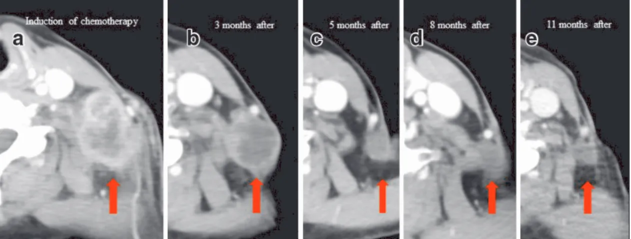 Fig. 4 Tumor shrinkage over time (in order from a to e). The tumor shrank rapidly and eventually touched only the scar (e).
