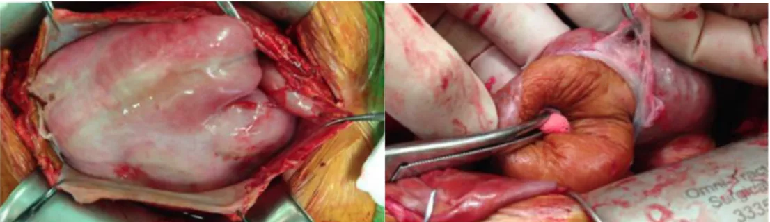 図 1 EPS 進行例における abdominal cocoon の肉眼的所見    