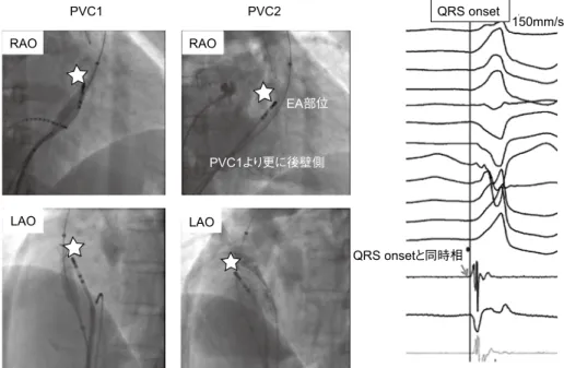 図 7 PVC2 の RVOT non–contact mapping  により最早期興奮部位に留置したカテーテル の透視位置と局所電位RAOLAO RAO QRS onsetPVC1PVC2 150mm/sQRS onsetと同時相EA部位PVC1より更に後壁側LAO 図8 PVC2 のR VOT最早期興奮部位の位置確認：右室造 影および大動脈造影RAOLAO右室造影 大動脈造影EA部位RVOT後壁 右冠尖右冠尖