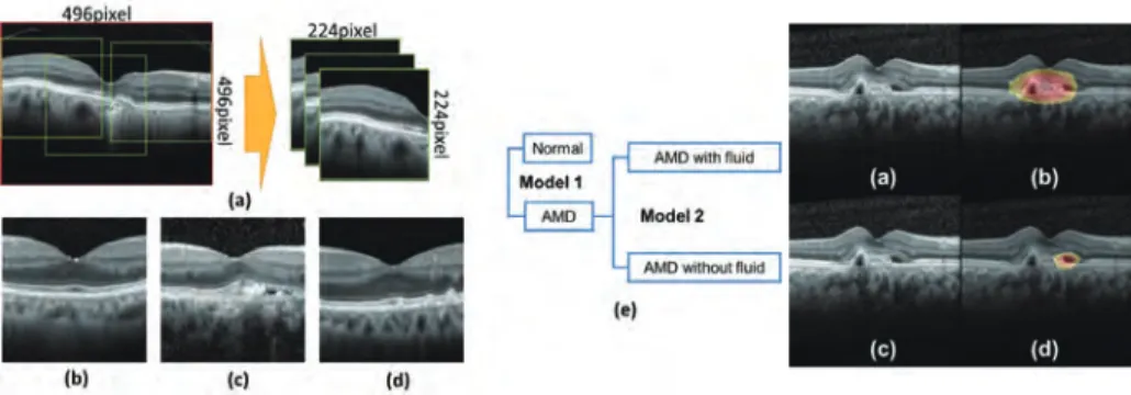 Fig. 1. Proposed approach for building machine learning model for  classification of normal and AMD. 
