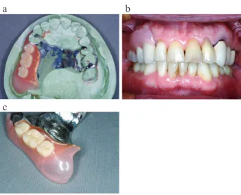 図 10 A non-metal clasp denture without metal element  used for an immediate denture (Reigning Ⓡ ) in a  patient with multi-tooth loss