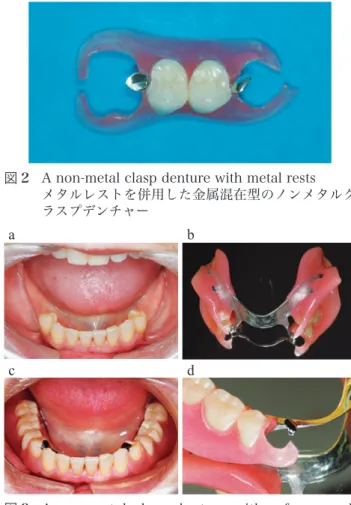 図 2  A non-metal clasp denture with metal rests メタルレストを併用した金属混在型のノンメタルク ラスプデンチャー