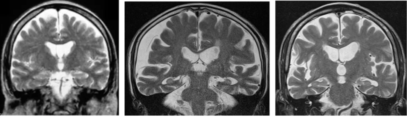 図 2  図 3  図 3 は正常な人の画像ですが、脳脊髄液の異常な貯留は認められません。  手術で改善するかどうかを判断するための診断方法はいくつか提案されていますが、腰 椎穿刺（背中から針を刺す）で脳脊髄液を捨てて症状が改善するかを見るテスト（タップ テスト、tap test）が一番簡単で、安全かつ確実性が高いと考えています。評価する症状 としては、歩行（3m TUG: Time Up &amp; Go、3m の距離を往復歩行する時間を測定する）、