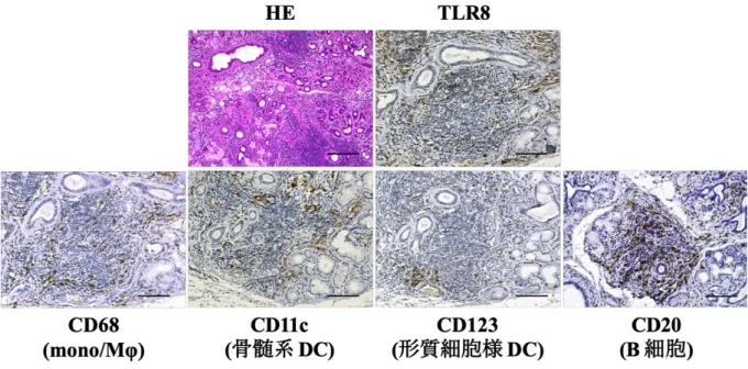 図 12.  SS の⼝唇腺における TLR8 の発現と局在 Scale bars: 100 µm  2-4.  ⼝唇腺における TLR8 の発現細胞の検索          これらの結果を考慮して、実際に SS 患者の⼝唇腺における主な TLR8 発現細胞の検索のために、蛍光⼆重免疫染⾊を⾏った。代表的な症例を図 13 に⽰すが、TLR8 は主に mono/MΦ（CD 68 陽性細胞）と局在が⼀致し た。さらに、17 例の SS 患者に対して蛍光⼆重免疫染⾊を⾏い、各細胞の TLR8 陽性率を半定量的に解