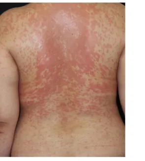 図 1  多形紅斑（セレコキシブによる薬疹）  （３）臨床検査値  CRP の上昇、白血球上昇もしくは白血球減少、軽度の肝機能障害、腎機 能障害をみることがある。感染症に伴う多形紅斑では、ASO（抗ストレプト リジンＯ抗体）値の上昇、単純ヘルペスなどのウイルス抗体価やマイコプ ラズマ抗体価の変動を認めることがある。  （４）画像検査所見    稀に胸部レントゲン写真で肺炎像を呈することがある。  （マイコプラズマ肺炎との鑑別が必要となる）  （５）病理組織所見  真皮上層の浮腫と表皮への炎症細胞浸潤、軽度の