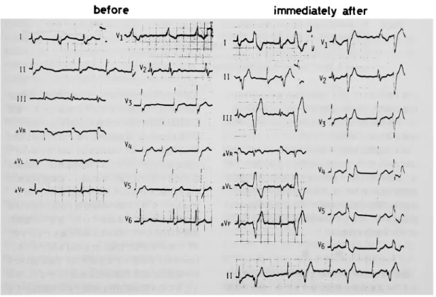 Fig.  3  Electrocardiograms  which  showed  ventricular  prem ature  beats,  bigeminy,  immediately  after  the  exercise.
