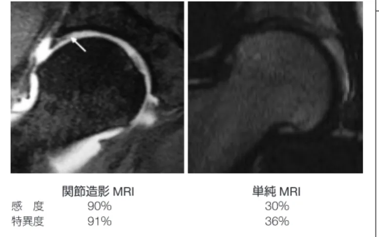 図 4　股関節唇損傷（関節造影 MRI 像） （ Czermy et al,Rediology 1996 ）関節造影MRI感 度90％特異度91％単純MRI30％36％