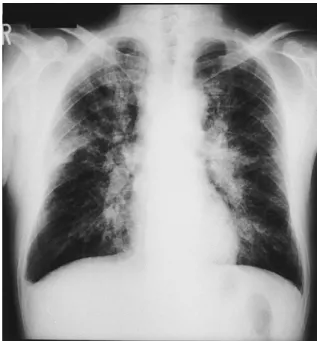 Fig. 1 Chest radiography on first admission showing diffuse ground glass opacities in both lung fields.