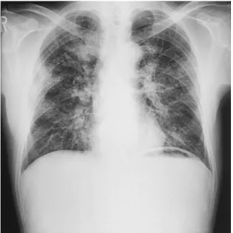 Fig. 8 Chest radiography on second admission showing diffuse ground glass opacities and infiltrates in both lung fields.