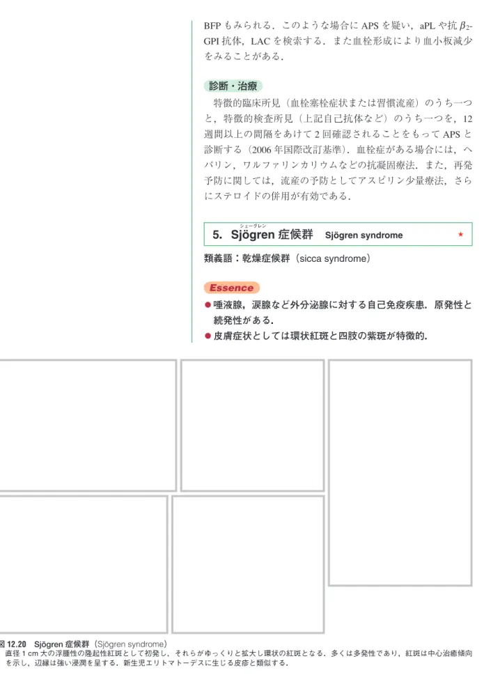 図 12.20　Sjögren 症候群（Sjögren syndrome）