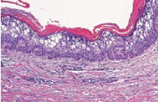 図 2.11　海綿状態（spongiosis）：急性湿疹