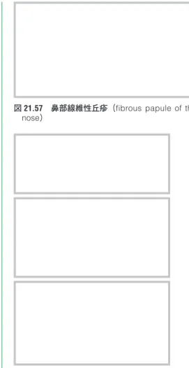 図 21.57　鼻部線維性丘疹（fibrous  papule  of  the  nose）