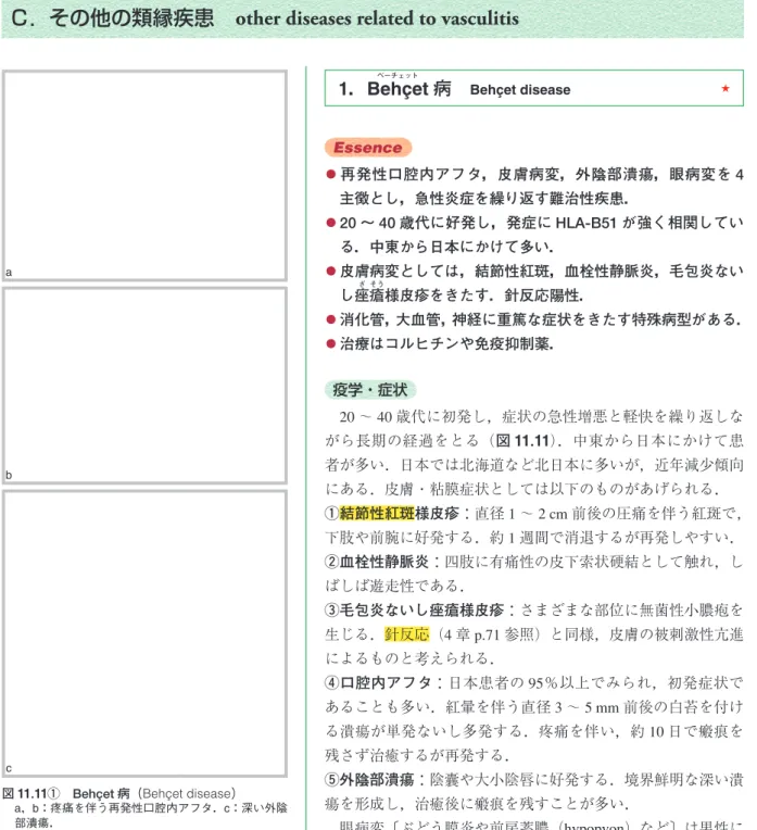 図 11.11①　Behçet 病（Behçet disease）