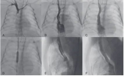 Fig. 2  Thrombi aspirated by sheath introducer.