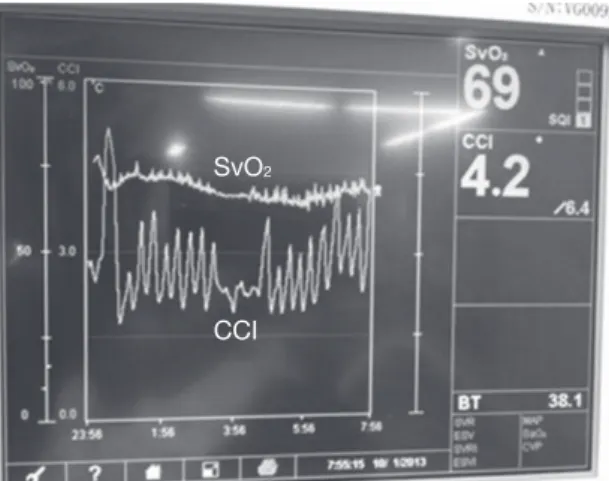 Fig. 1  A typical pattern of rhythmic fluctuation of CCI（CCI oscillation）