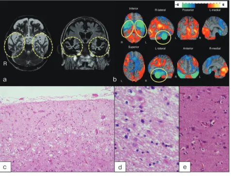 図 8　白質ジストロフィー症例の画像，病理所見 a：MRI 画像。両側側脳室周囲の皮質下白質にび慢性の T2 高信号を認める。また両側前頭葉の萎縮を認める。さらに脳幹が萎 縮している（上段中央の画像）。b：前頭葉の KB（Klüver-Barrera）染色セミマクロ像。c の対照例と比較して，皮質下白質の染色 性が消失していることがわかる。d：前頭葉白質の Bodian 染色所見。軸索がほぼ消失していることが示されている。e：前頭葉 白質の HE 染色所見。f の対照例と比較して，染色性が消失しており，また