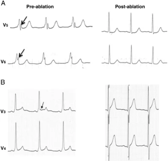 Fig 4  Δ波存在下での J 波 A 、 Fig 3 の症例の拡大波形、 V5 、 V6 誘導でΔ波とともに巨大な J 波が認められる（左） 、 術後、 QRS 波形は正常化し、 J 波は消失している（右） 、 B 、Δ波存在下でのみ J 波が出 現した他の症例、 V3 、 V4 誘導でΔ波と J 波および ST 上昇が認められる（左） 、術後、 J 波は消失したが ST 上昇は持続した（右）