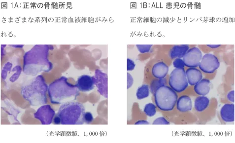 図 1A：正常の骨髄所見  さまざまな系列の正常血液細胞がみら れる。  図 1B：ALL 患児の骨髄  正常細胞の減少とリンパ芽球の増加がみられる。        1970 年代から用いられてきた FAB 分類では芽球の形態により ALL の 細胞は L1、L2、L3 に分けられていましたが、現在ではその分類は大 きな意味がないとされています。より重要なのは、芽球の細胞表面に 出ている分子（抗原、マーカー）を調べることです。細胞表面には細 胞系列によってそれぞれ特異なマーカーが出ています（次頁表 1）。た