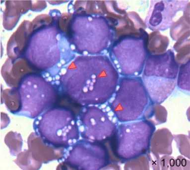 図 2. MEF2D-BCL9 融合遺伝子をもつ白血病細胞  典型的な B 前駆細胞性 ALL とは異なり、細胞が大きく、細胞質の青味が強く、白く抜け た空胞（△）を多くもつ特異な形態を示します。  ３．今後の展開    本研究により発見され、その機能が明らかとなった MEF2D-BCL9 融合遺伝子は、分子 マーカーとしてリスク層別化や治療効果の判定に早期の実用化が可能と考えられます。ま た、この融合遺伝子を持つ白血病に対しての、分子標的薬を組み入れた新しい治療方針の 策定や、この融合遺伝子を標的とした新