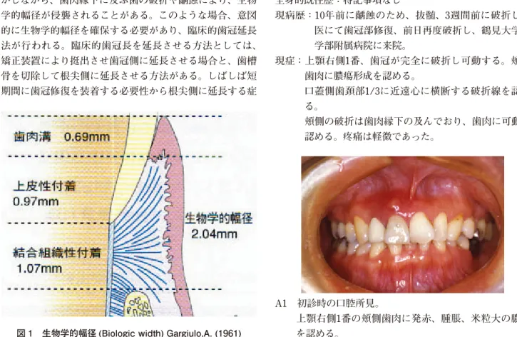 図 1　生物学的幅径 (Biologic width) Gargiulo,A. (1961)