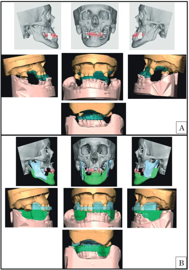 Fig. 3 　シミュレーション画像 Bite Splint 装着時 A：Bite Splint 0（術前）の画像