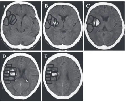 Table 2.  Persisting aphasia and location of hemorrhage