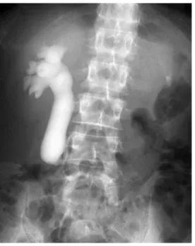 Fig. 2.  Computed tomography during excretory urog- urog-raphyshows existence of a retrocaval ureter.