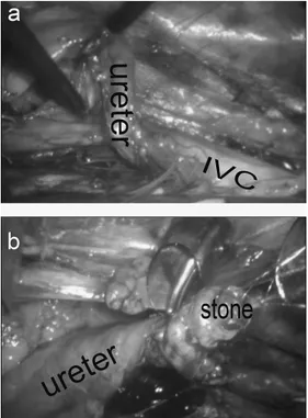 Fig. 3.  (a) The retrocaval ureter found to override the vena cava. (b) The upper portions of the right ureter was identified and renal pelvic stone was held with basket catheter.