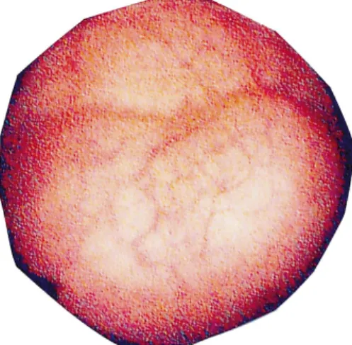 Fig. 1. Cystoscopy showed a smooth surfaced mass, diameter of 2 cm, in the left lateral wall.