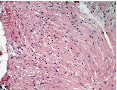 Fig. 4. Histological examination discloses an increase of spindle cells with interlacing fascicular pattern