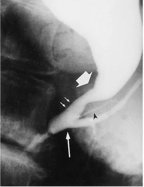 Fig. 3. ERCP of a 65-year-old woman with Group B PBM, CCBD and  gallblad-der cancer.