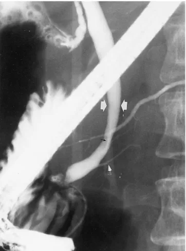 Fig. 7. ERCP of a 55-year-old woman with Group C PBM, partial pancreas divisum and gallbladder cancer.