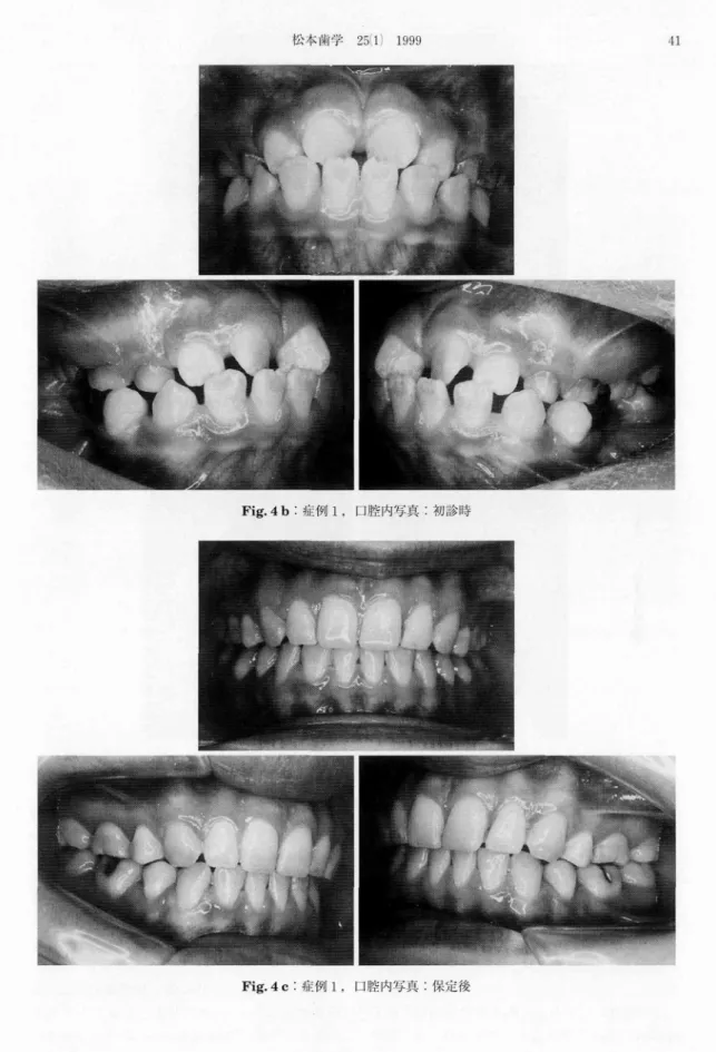 Fig． 4 b：症例1．口腔内写真：初診時