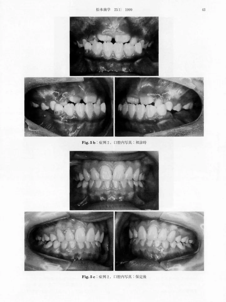 Fig． 5 b：症例2、口腔内写真：初診時