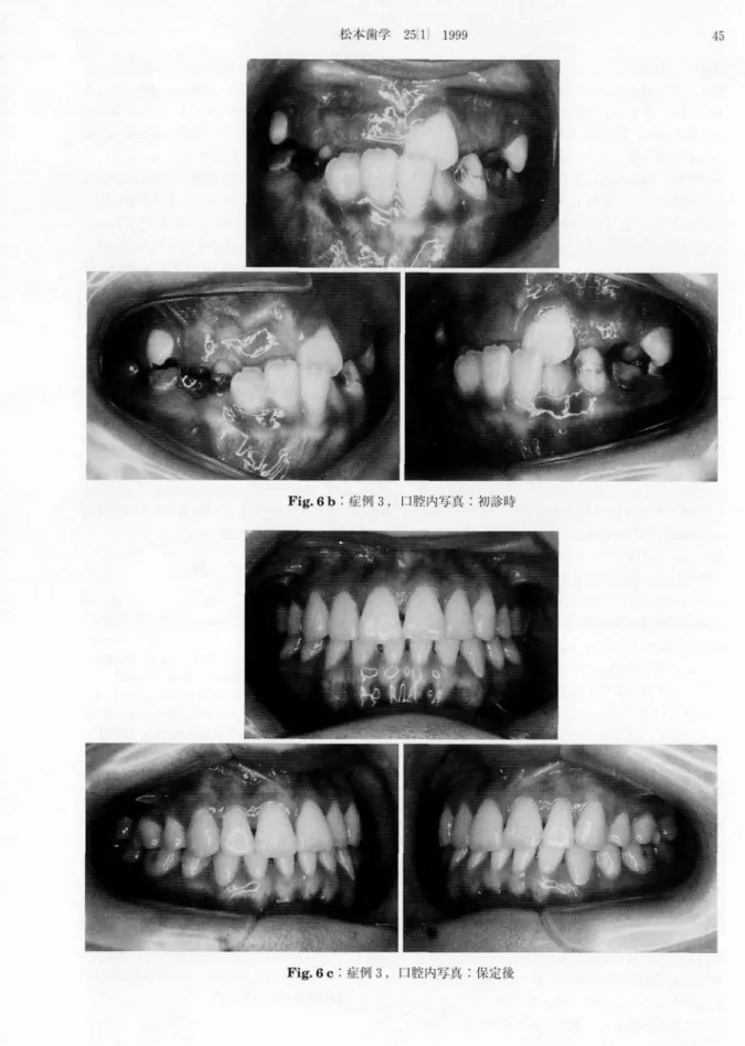 Fig． 6 b：症例3，口腔内写真：初診時