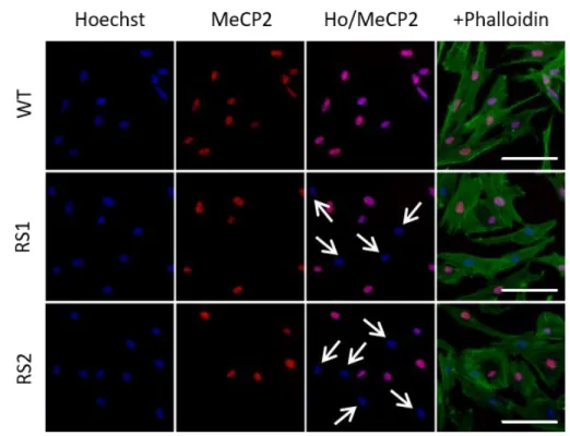 Figure 1. Immunostaining for MeCP2 (red) and phalloidin (green) along with  Hoechst  staining  (blue)  of  wild-type  MECP2 -  and  mutant  MECP2 -expressing  fibroblasts